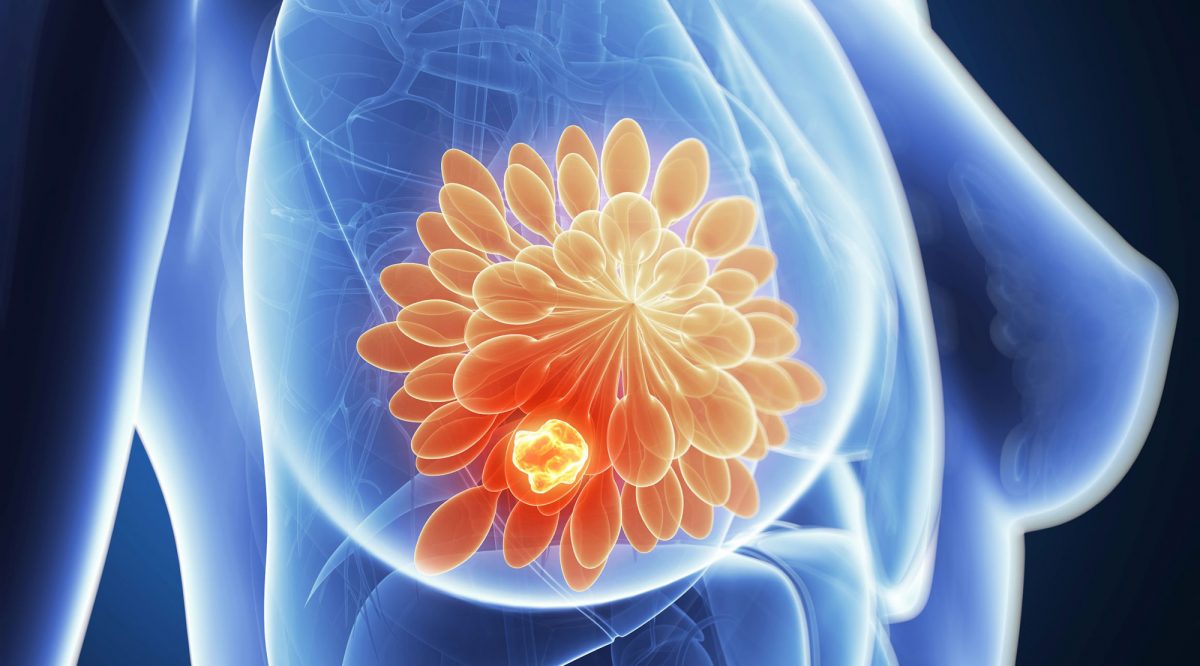 Enhertu: Most Powerful Drug to Treat Advanced HER2-Positive Breast Cancer