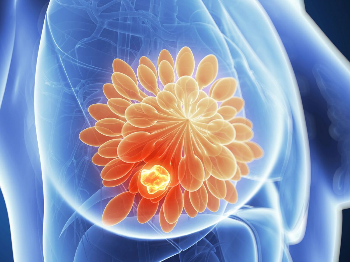 Enhertu: Most Powerful Drug to Treat Advanced HER2-Positive Breast Cancer