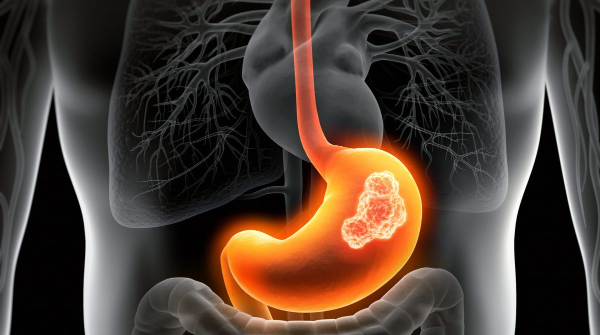 gastric cancer opdivo