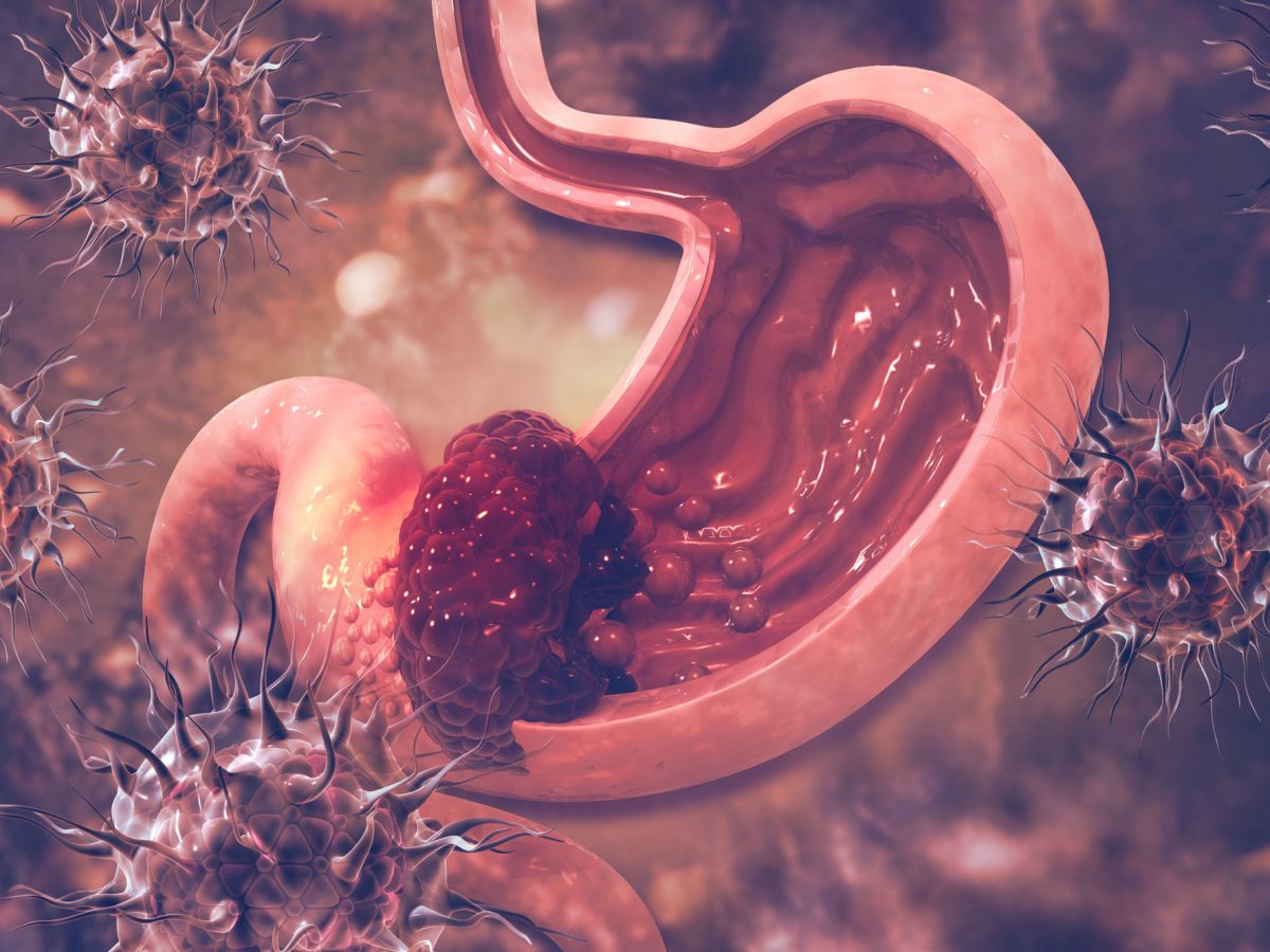 Bemarituzumab: Breakthrough in Gastric Cancer Treatment