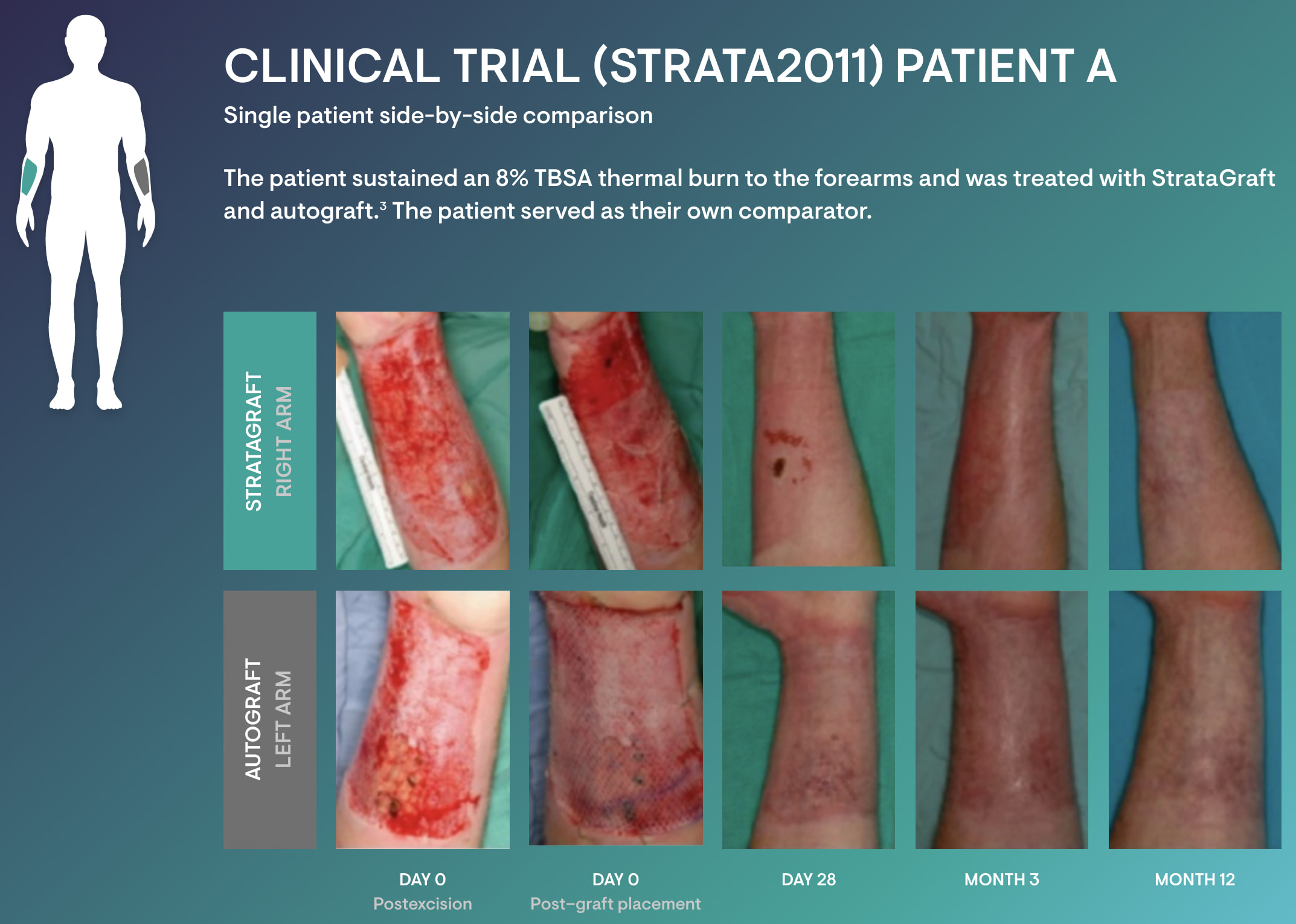 stratagraft cosmesis 01 - StrataGraft: Artificial Skin for Treatment of Severe Thermal Burns