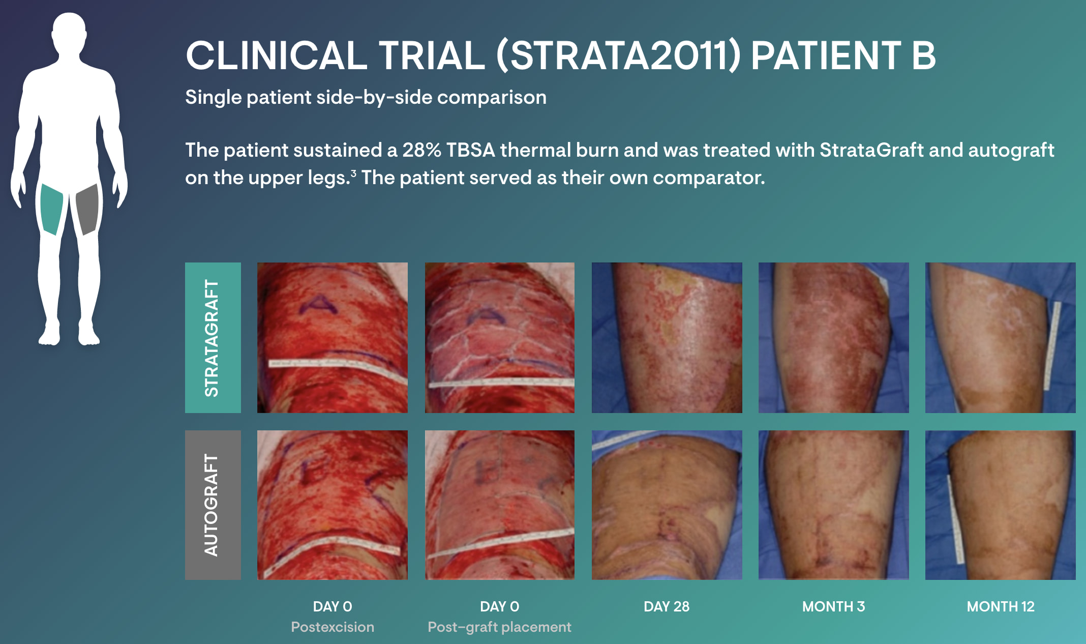 stratagraft cosmesis 02 - StrataGraft: Artificial Skin for Treatment of Severe Thermal Burns