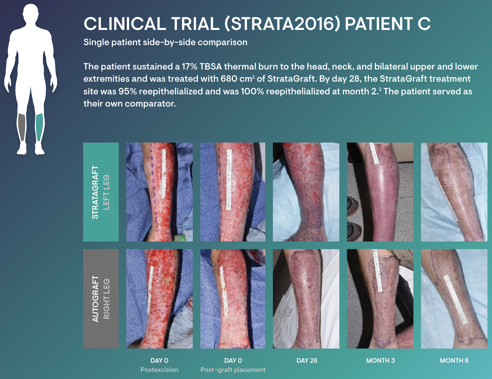 stratagraft cosmesis 03 - StrataGraft: Artificial Skin for Treatment of Severe Thermal Burns