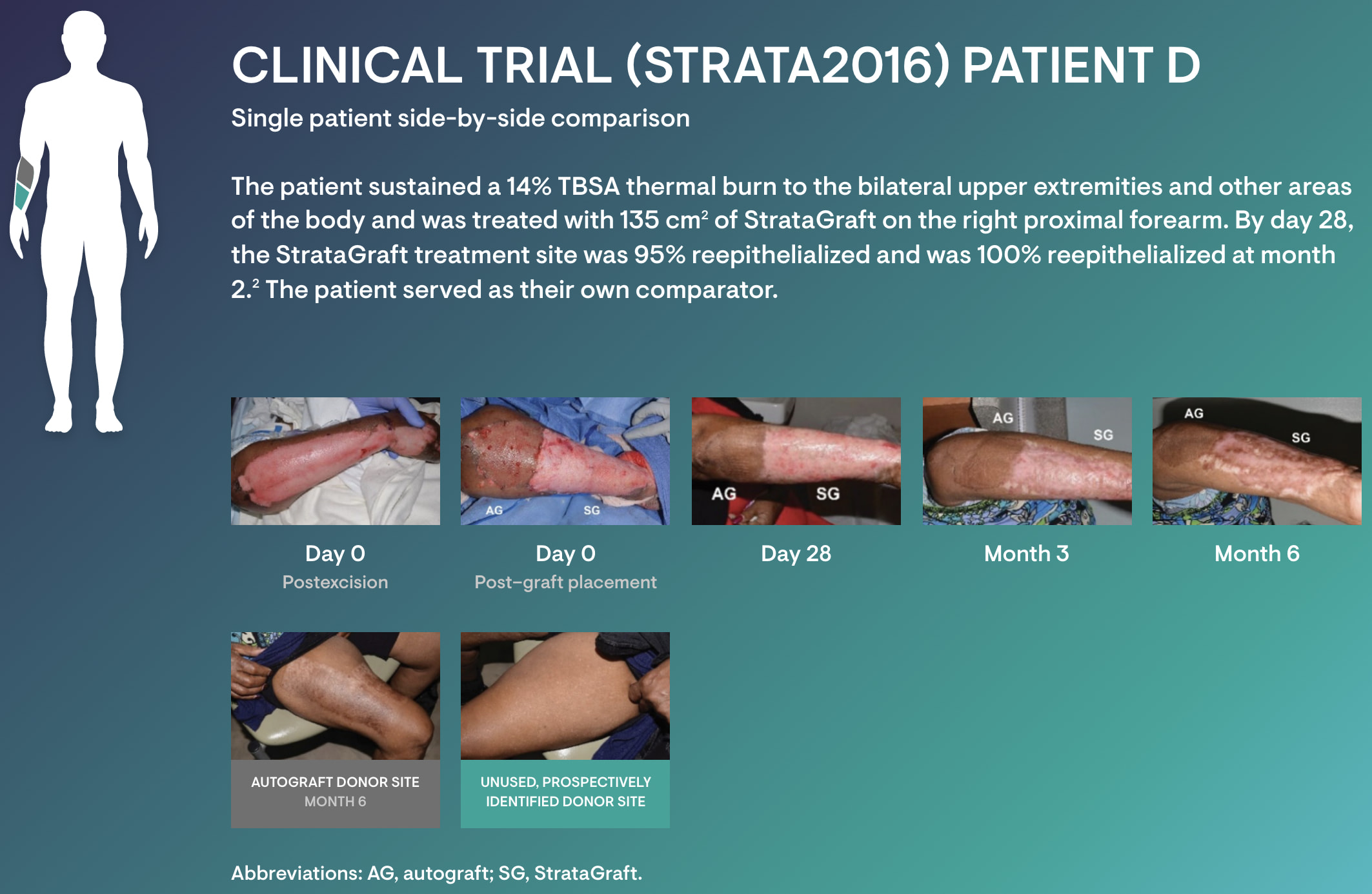 stratagraft cosmesis 04 - StrataGraft: Artificial Skin for Treatment of Severe Thermal Burns