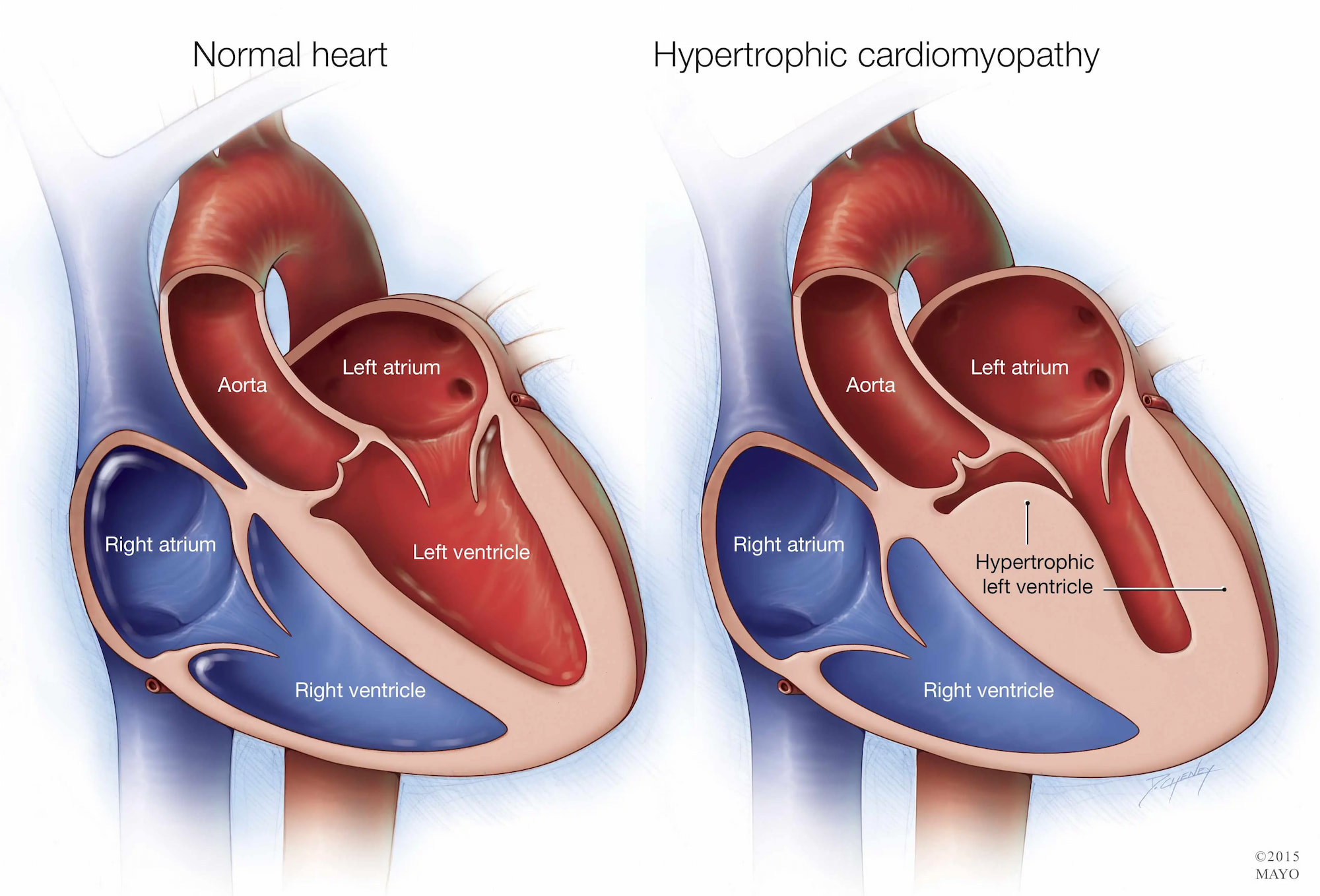 hypertrophic cardiomyopathy