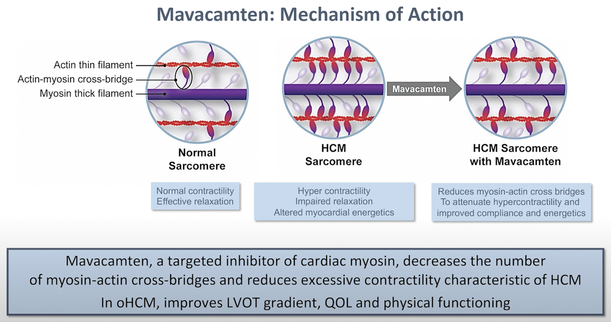 mavacamten moa - Camzyos: First Specific Drug to Treat Hypertrophic Cardiomyopathy