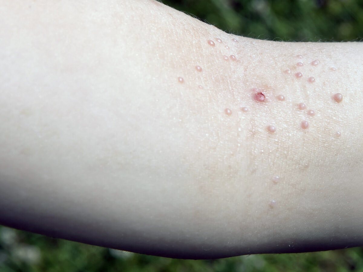 Ycanth: First Treatment for Molluscum Contagiosum and Warts