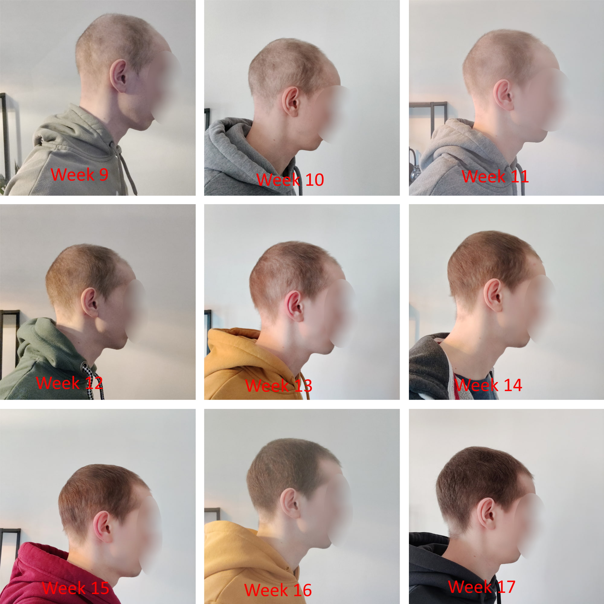 deuruxolitinib alopecia areata results 02 - Alopecia Areata Treatment: What Future Holds