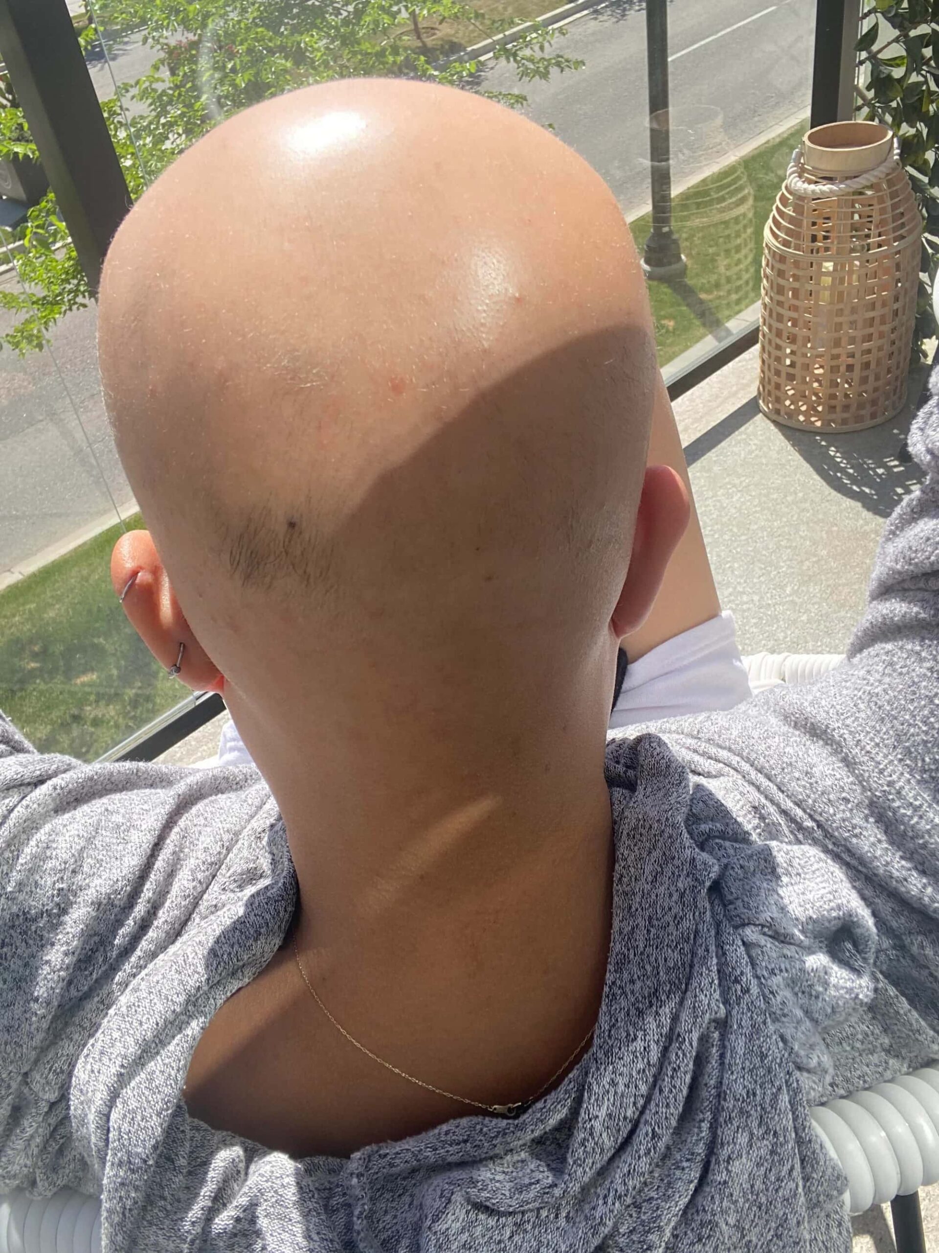 deuruxolitinib alopecia areata results 05 scaled - Alopecia Areata Treatment: What Future Holds