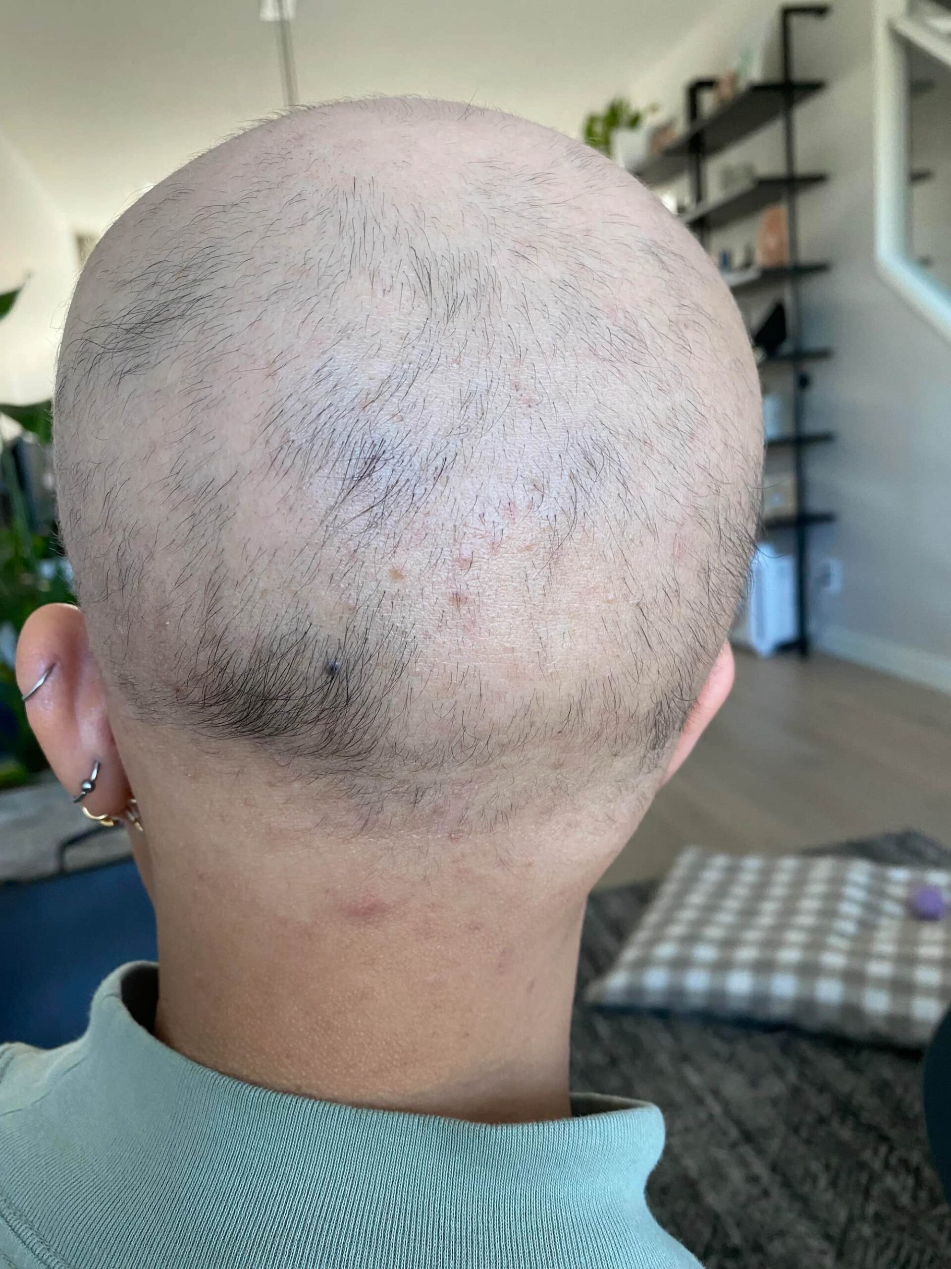 deuruxolitinib alopecia areata results 06 scaled - Alopecia Areata Treatment: What Future Holds