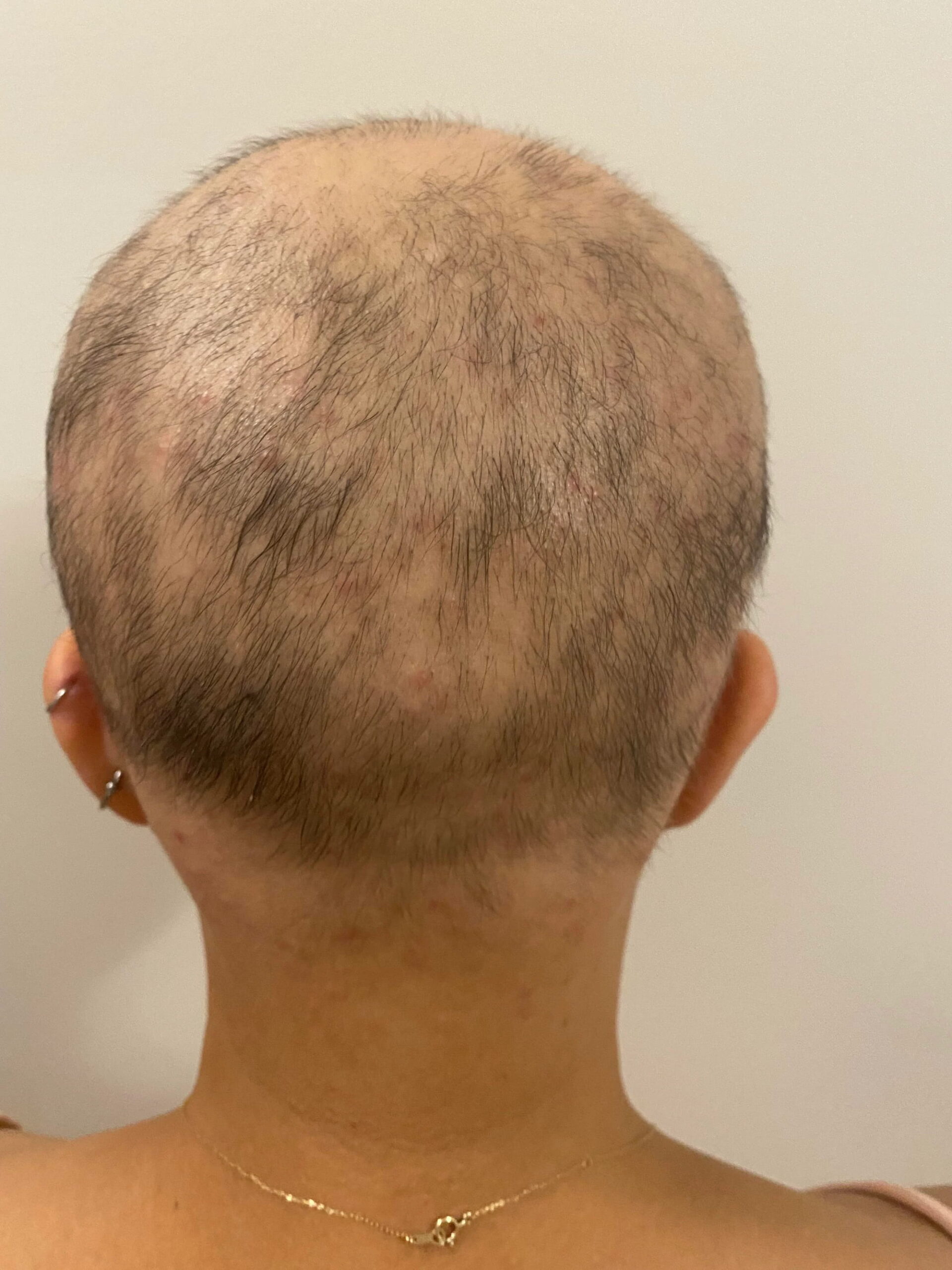 deuruxolitinib alopecia areata results 07 scaled - Alopecia Areata Treatment: What Future Holds