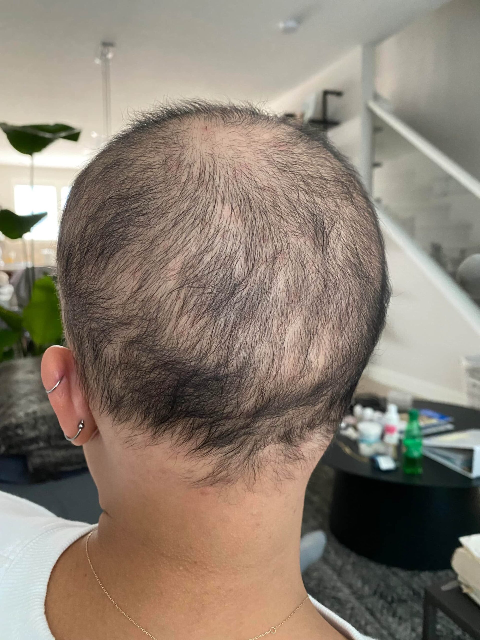 deuruxolitinib alopecia areata results 08 scaled - Alopecia Areata Treatment: What Future Holds