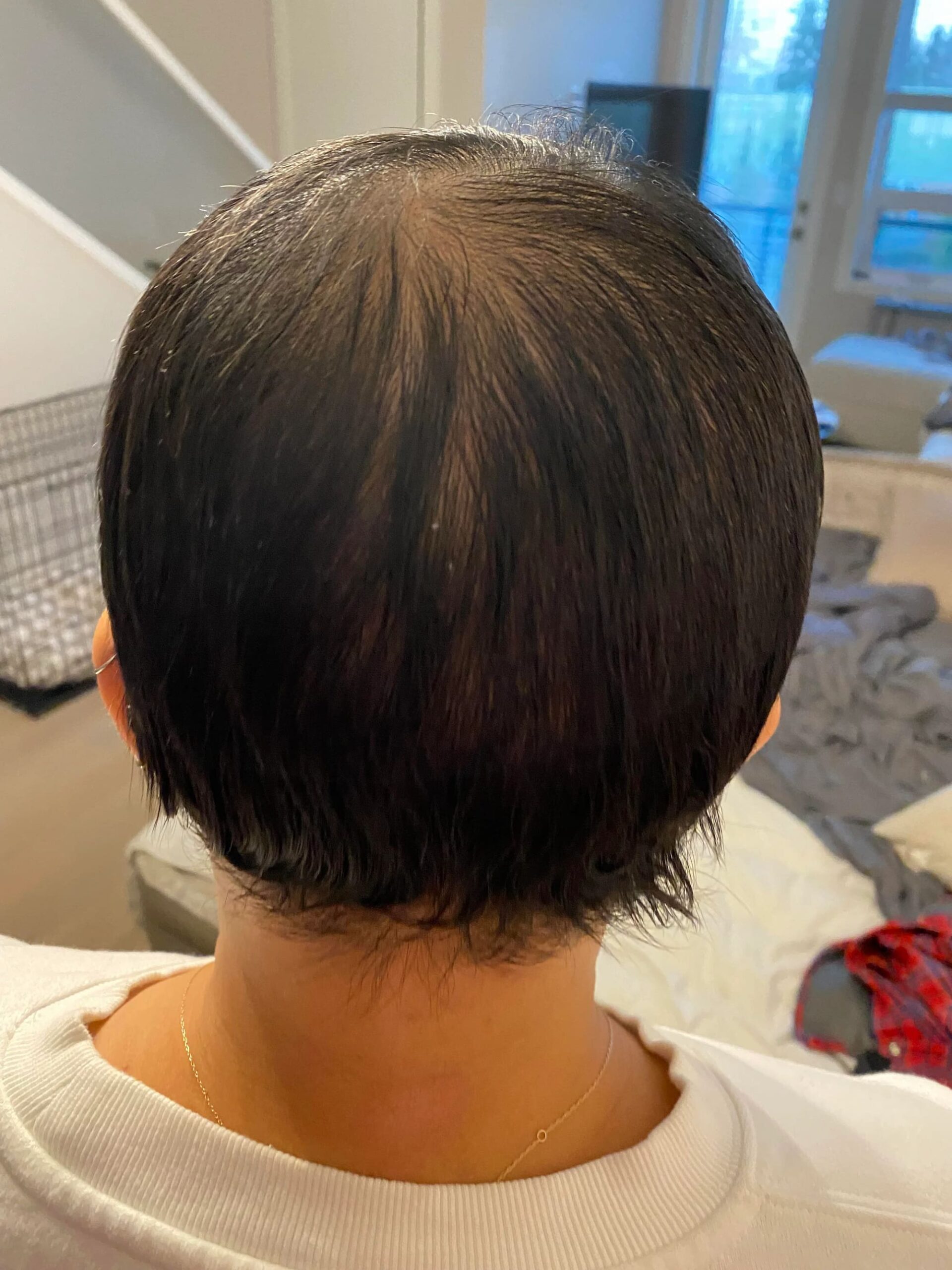 deuruxolitinib alopecia areata results 09 scaled - Alopecia Areata Treatment: What Future Holds