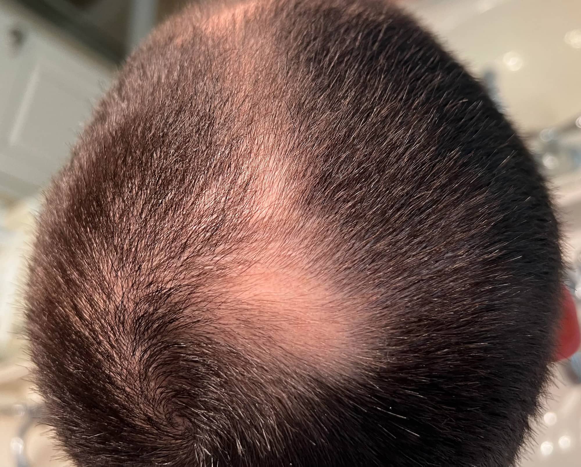 deuruxolitinib alopecia areata results 15 - Alopecia Areata Treatment: What Future Holds