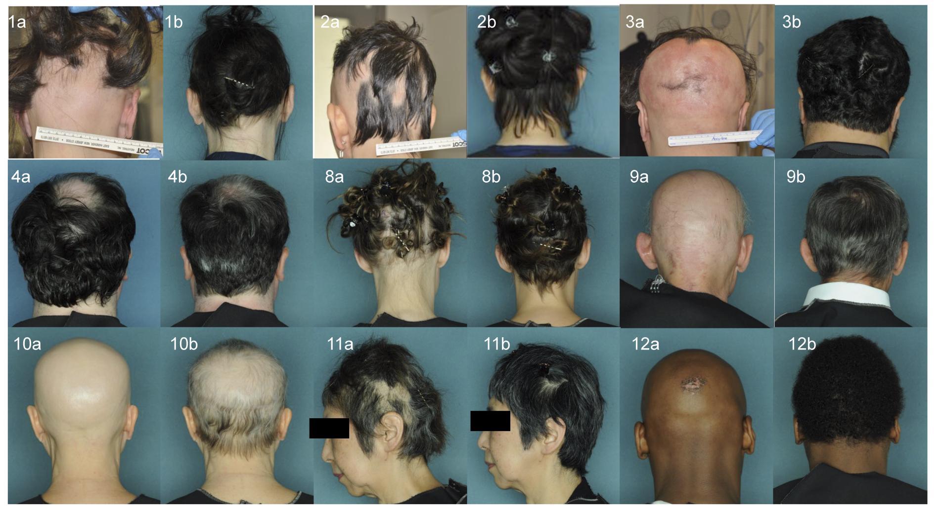 ruxolitinib alopecia areata results 01 - Alopecia Areata Treatment: What Future Holds