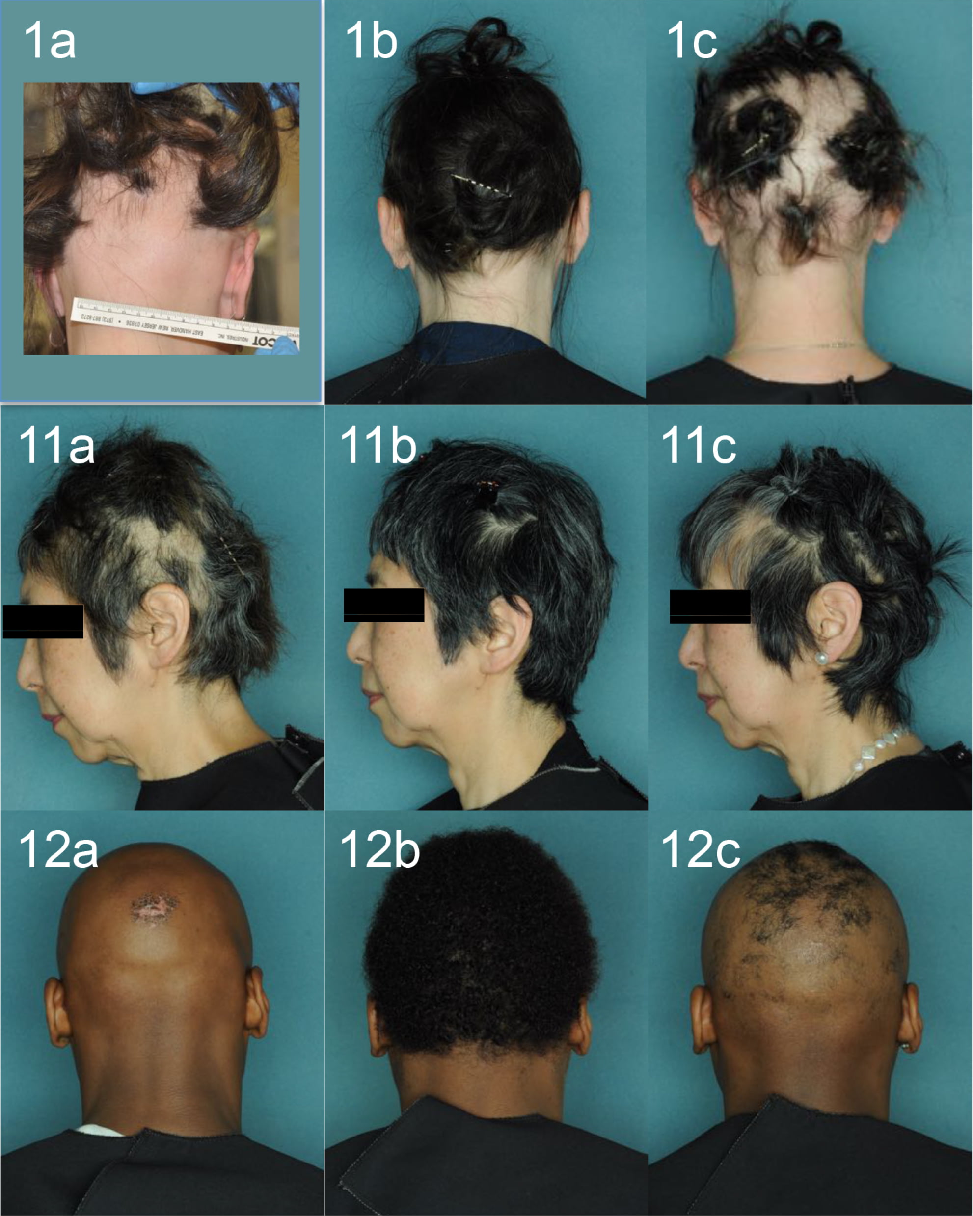 ruxolitinib alopecia areata results 02 - Alopecia Areata Treatment: What Future Holds