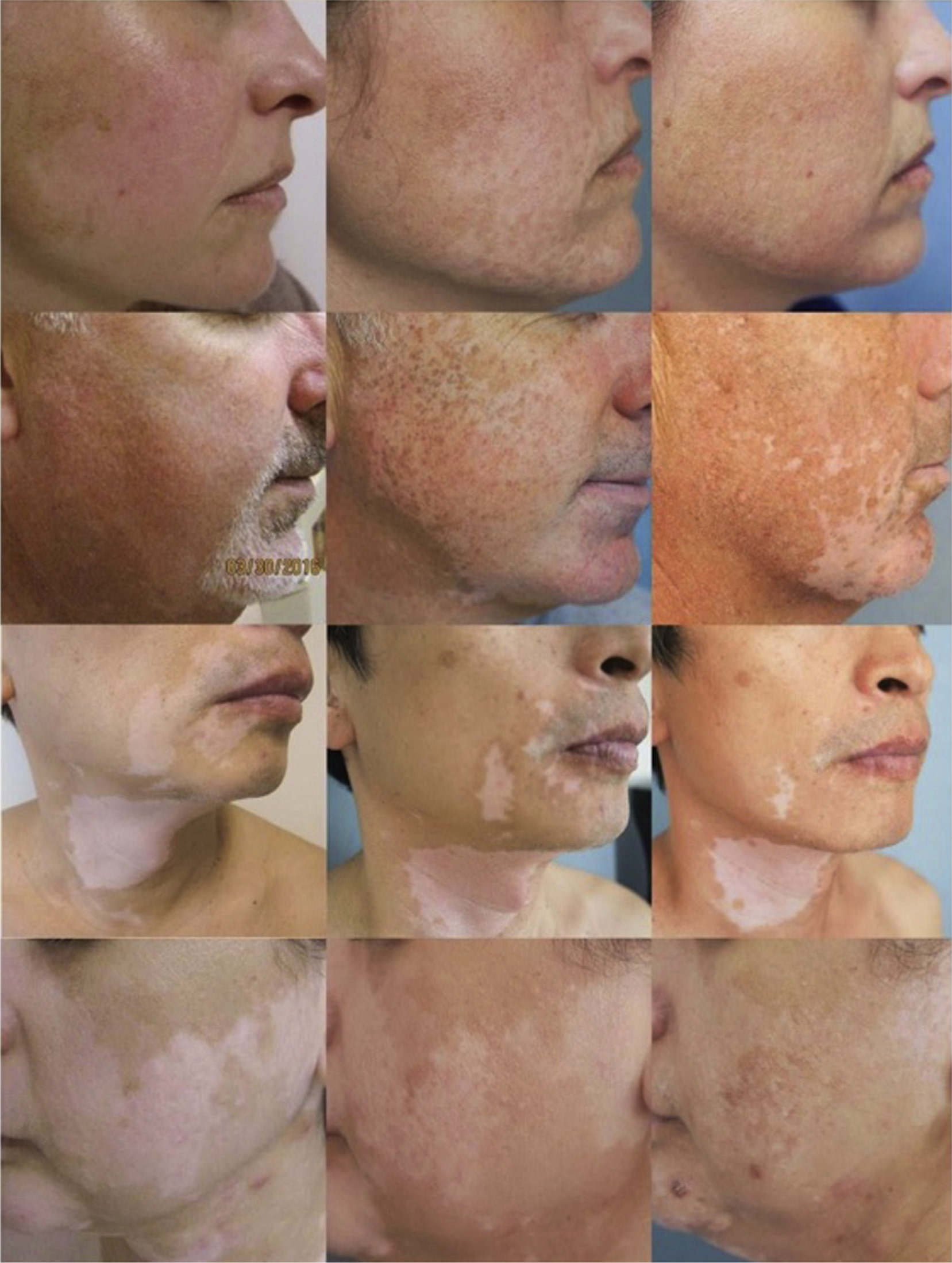 ruxolitinib vitiligo results 02 - Opzelura: New Treatment for Vitiligo