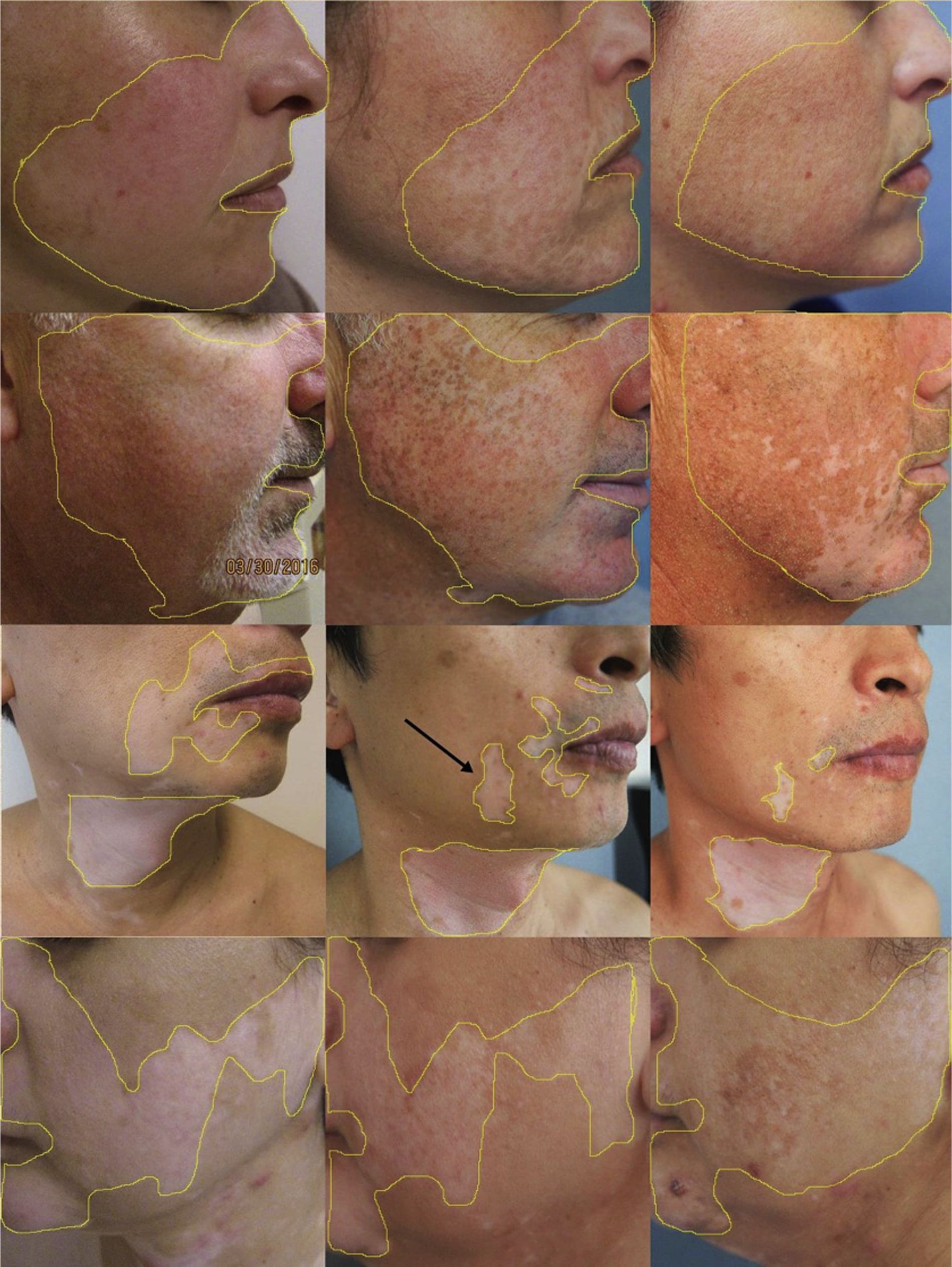 ruxolitinib vitiligo results 04 - Opzelura: New Treatment for Vitiligo