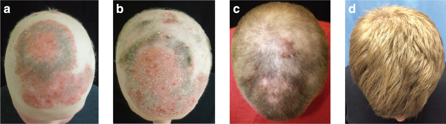 tofacitinib alopecia areata results 02 - Alopecia Areata Treatment: What Future Holds