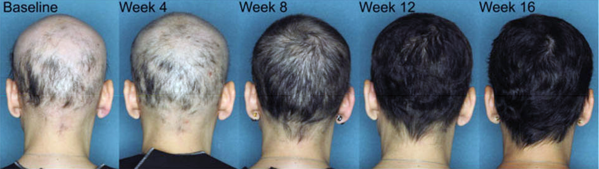 tofacitinib alopecia areata results 25 - Alopecia Areata Treatment: What Future Holds