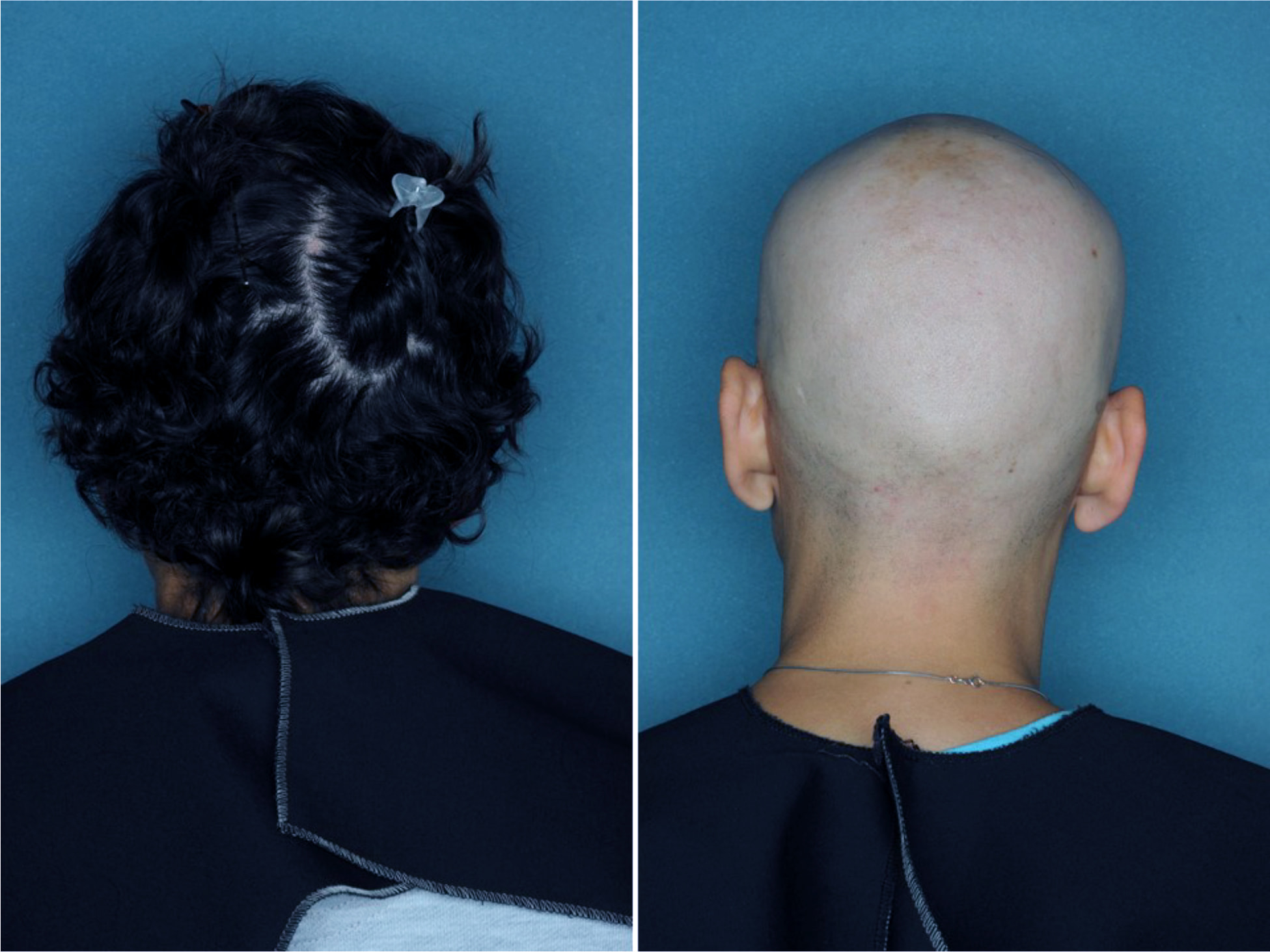 tofacitinib alopecia areata results 26 - Alopecia Areata Treatment: What Future Holds