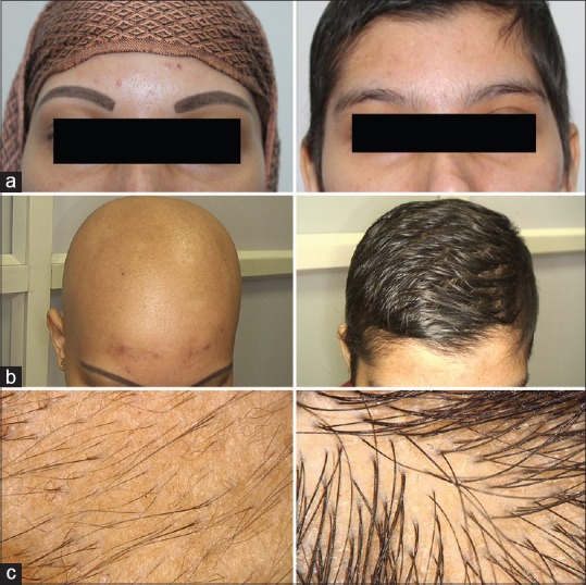 tofacitinib alopecia areata results 27 - Alopecia Areata Treatment: What Future Holds