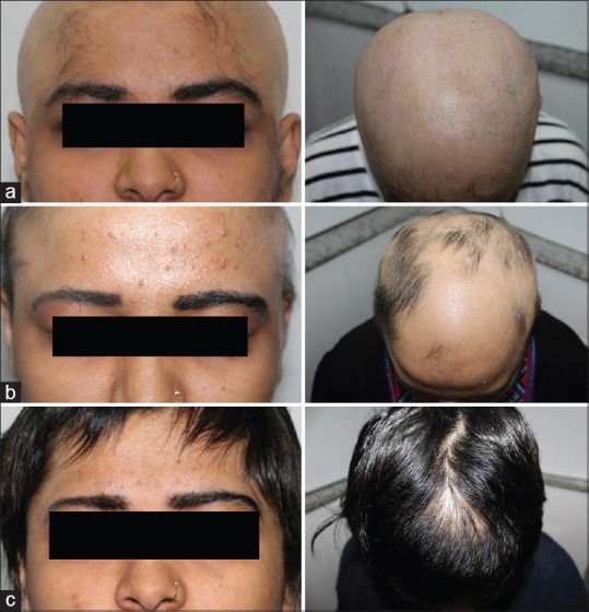 tofacitinib alopecia areata results 28 - Alopecia Areata Treatment: What Future Holds