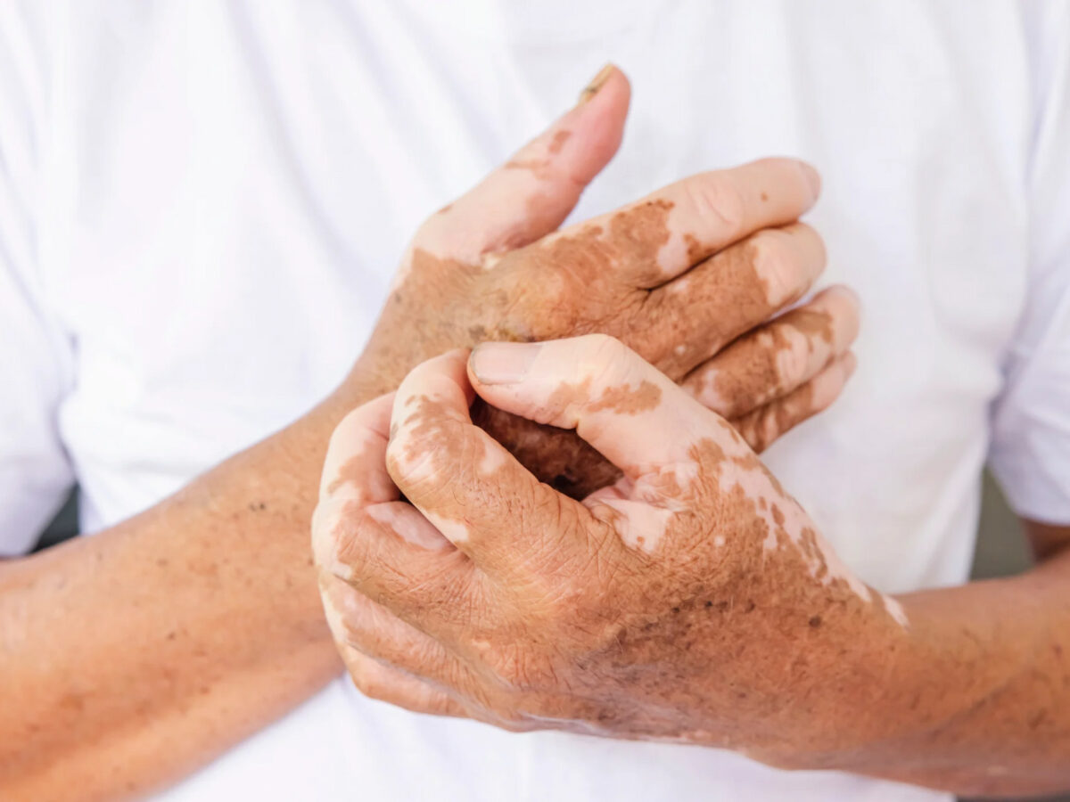 Opzelura: New Treatment for Vitiligo