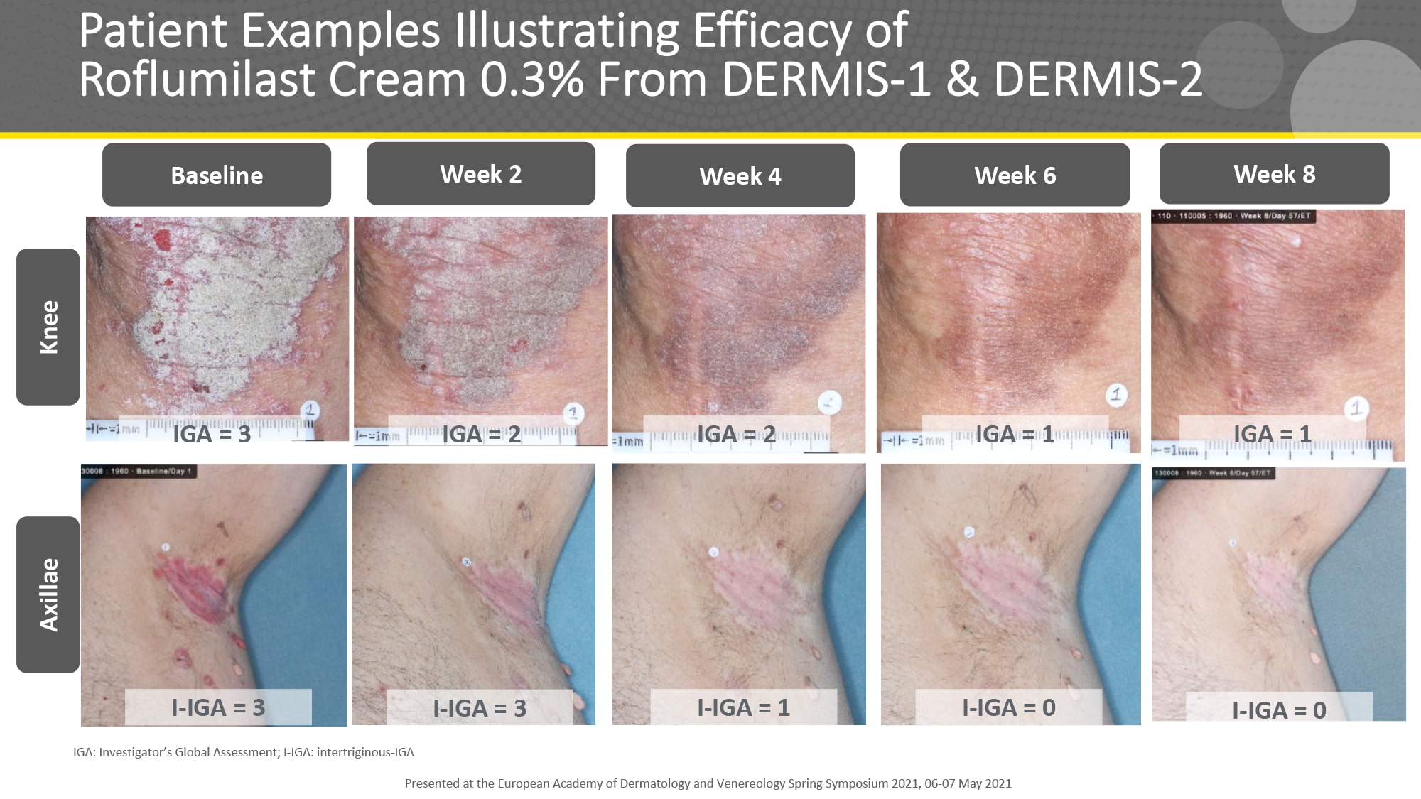 roflumilast psoriasis results 05 - Zoryve: New Effective Cream for Psoriasis