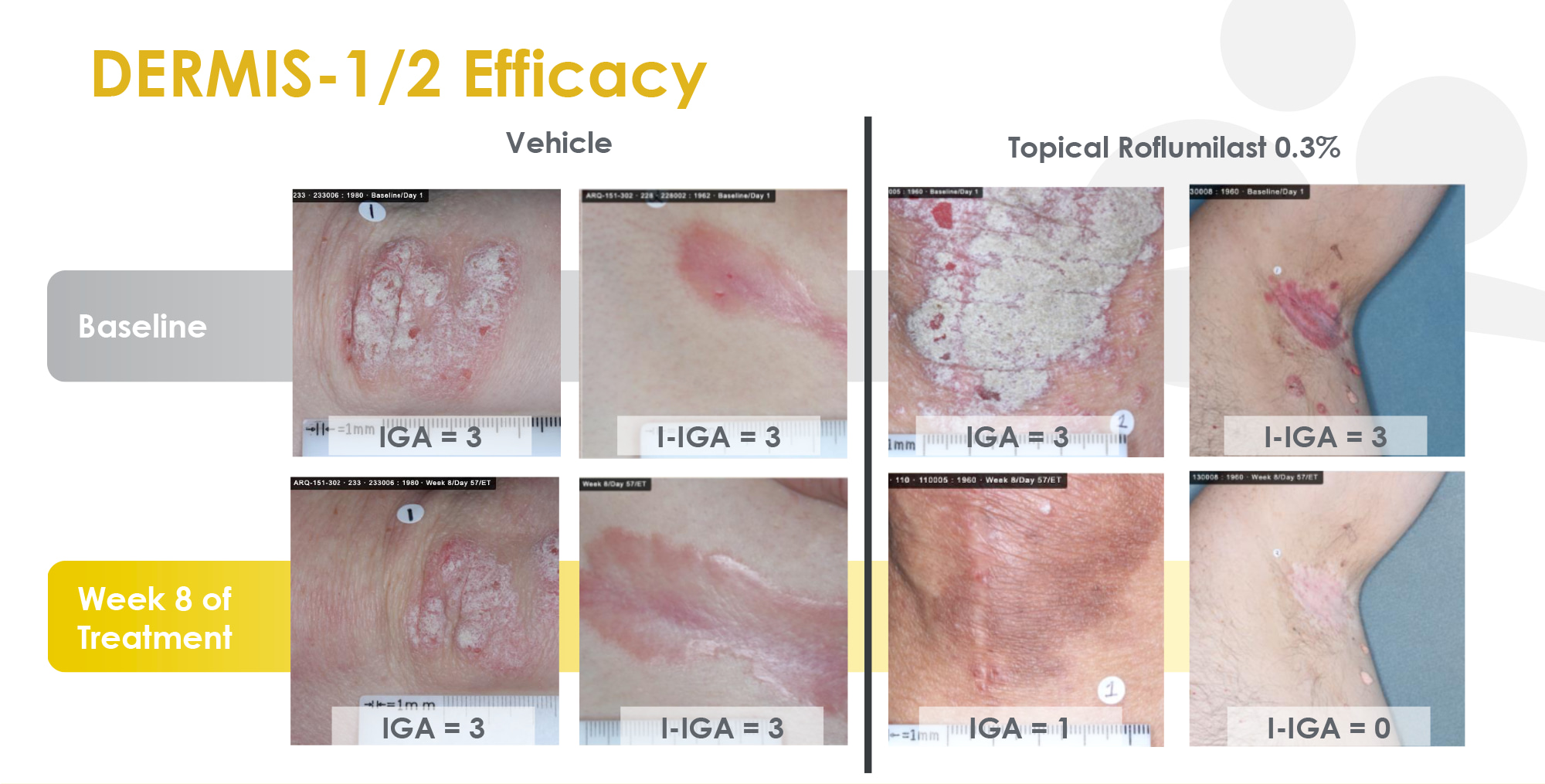 roflumilast psoriasis results 06 - Zoryve: New Effective Cream for Psoriasis