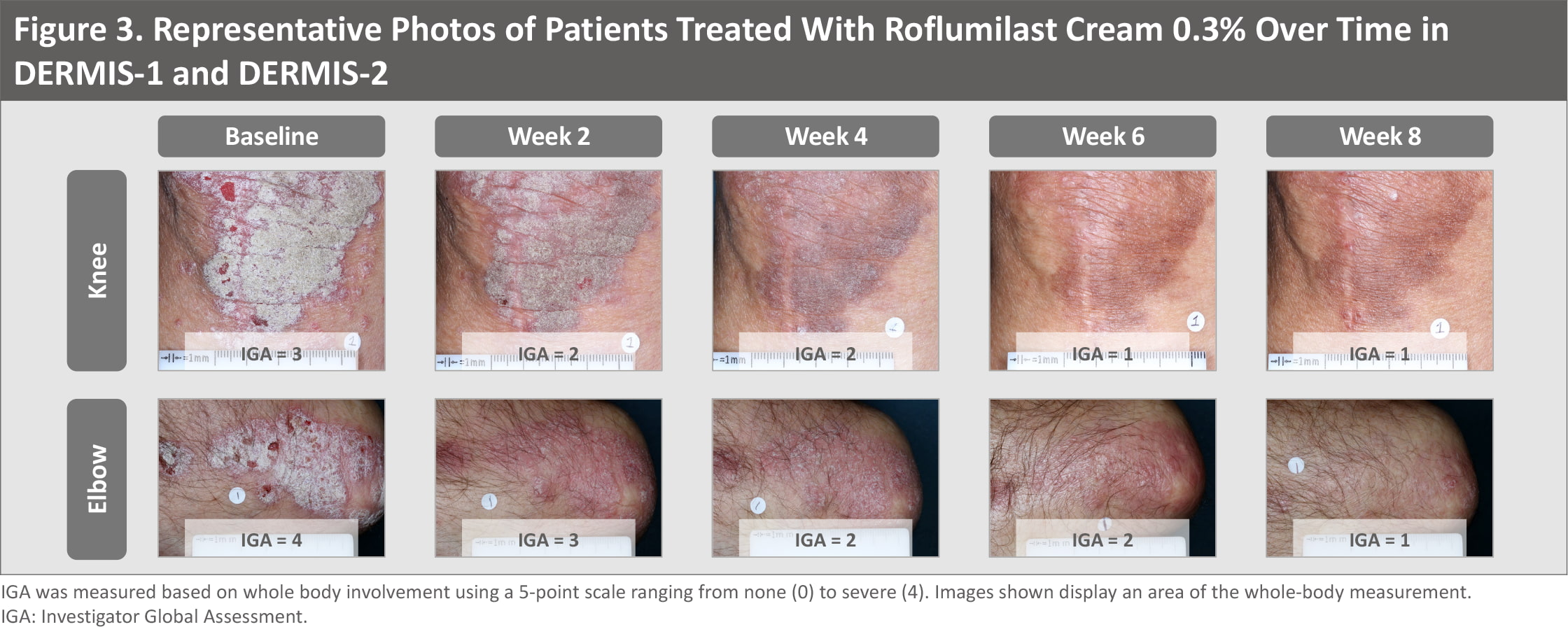 roflumilast psoriasis results 07 - Zoryve: New Effective Cream for Psoriasis