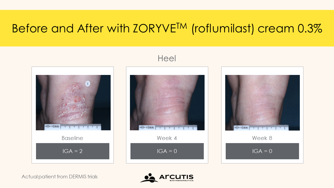 roflumilast psoriasis results 08 - Zoryve: New Effective Cream for Psoriasis