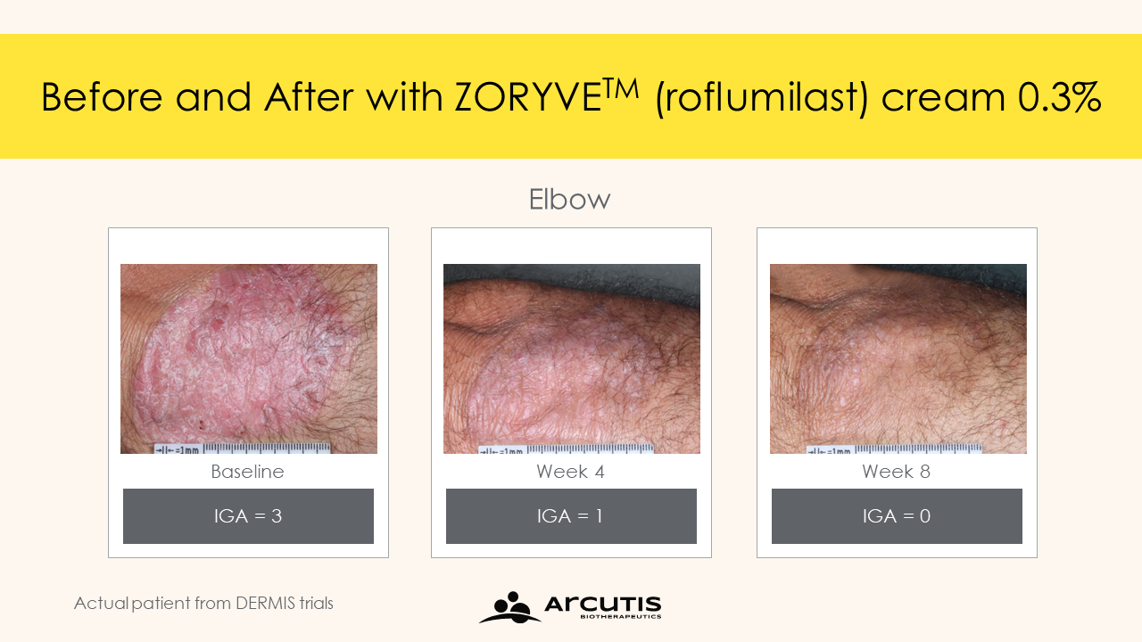 roflumilast psoriasis results 09 - Zoryve: New Effective Cream for Psoriasis