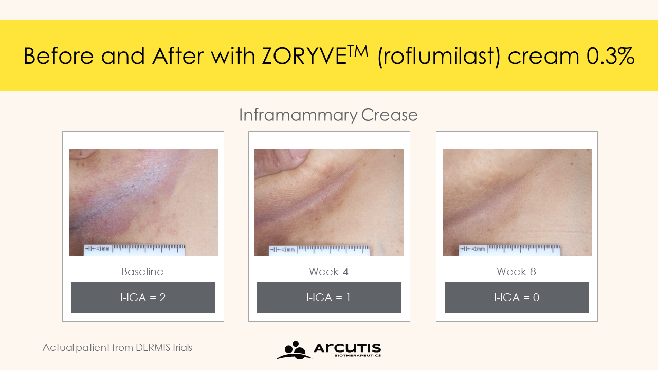 roflumilast psoriasis results 10 - Zoryve: New Effective Cream for Psoriasis